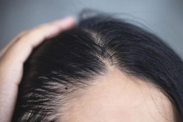 Những nốt ruồi xấu trên khuôn mặt phụ nữ