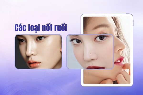 Những loại mụn ruồi ở mũi thường gặp