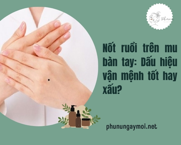 nốt ruồi trên mu bàn tay