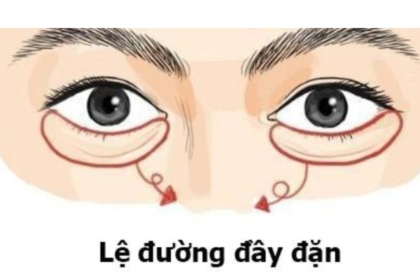 Lệ đường đầy đặn thì hậu vận của con cái hưởng đầy phúc lộc