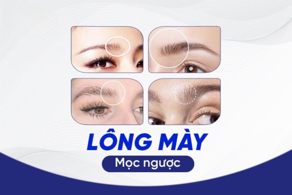 Lông mày mọc ngược là gì? Hãy cùng chuyên gia giải đáp ngay Lông mày mọc ngược là gì? Hãy cùng chuyên gia giải đáp ngay