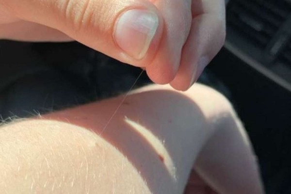 Có nên triệt lông tài hay không?