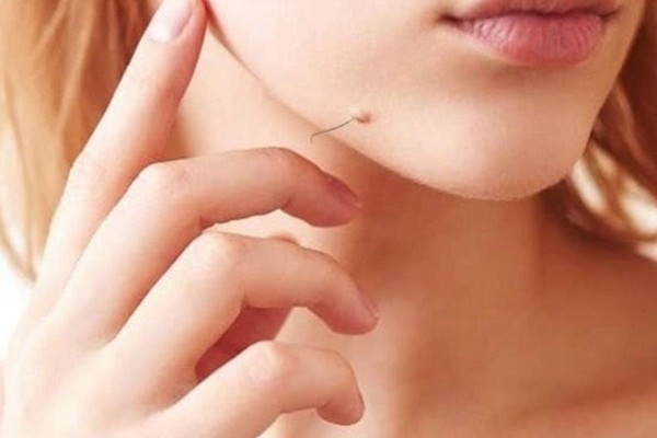 Nốt ruồi có lông ở dưới cằm – Dấu hiệu may mắn, hậu vận tốt Nốt ruồi có lông ở dưới cằm – Dấu hiệu may mắn, hậu vận tốt