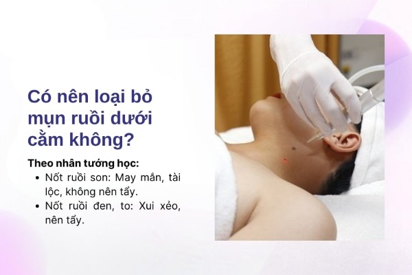 Có nên loại bỏ mụn ruồi ở cằm không? Có nên loại bỏ mụn ruồi ở cằm không?