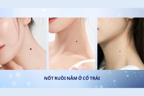 Nốt ruồi ở cổ – Mệnh tương đối vất vả vì gia đình Nốt ruồi ở cổ – Mệnh tương đối vất vả vì gia đình