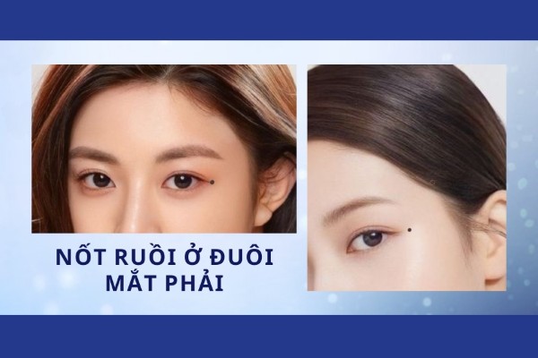 Nốt ruồi ở đuôi mắt phải – Nam giới dễ lập gia đình muộn Nốt ruồi ở đuôi mắt phải – Nam giới dễ lập gia đình muộn