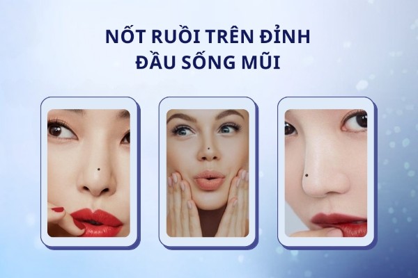 Nốt ruồi lận đận tình duyên nằm ở trên đỉnh sống mũi Nốt ruồi lận đận tình duyên nằm ở trên đỉnh sống mũi