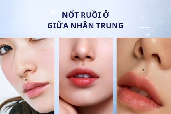 Nốt ruồi giữa nhân trung – Nam nữ đều gặp trắc trở Nốt ruồi giữa nhân trung – Nam nữ đều gặp trắc trở