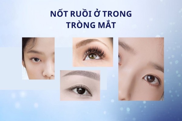 Nốt ruồi trong tròng mắt – Dễ có mâu thuẫn trong hôn nhân Nốt ruồi trong tròng mắt – Dễ có mâu thuẫn trong hôn nhân