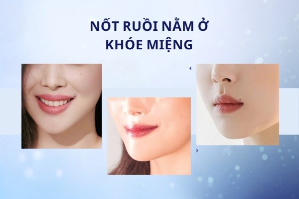 Nốt ruồi lận đận tình duyên nằm ở khóe miệng Nốt ruồi lận đận tình duyên nằm ở khóe miệng