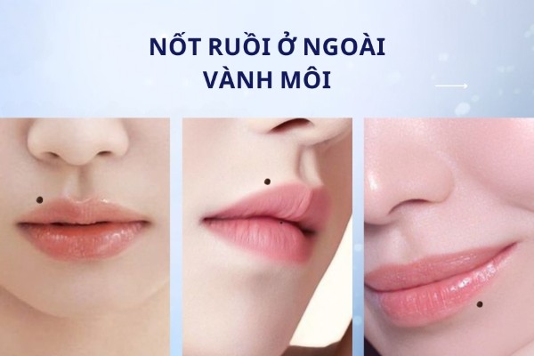 Nốt ruồi ở ngoài vành môi – Vướng vào thị phi, ngoại tình Nốt ruồi ở ngoài vành môi – Vướng vào thị phi, ngoại tình