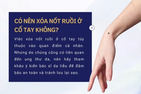 Có nên xóa nốt ruồi ở cổ tay không?