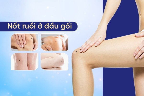 Ý nghĩa nốt ruồi ở đầu gối nam và nữ – Tướng hung hay cát?