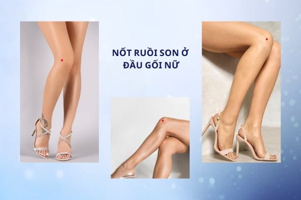 Nốt ruồi son trên đầu gối phải nữ có tốt không?