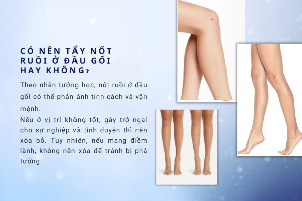 Có nên tẩy nốt ruồi ở đầu gối hay không?