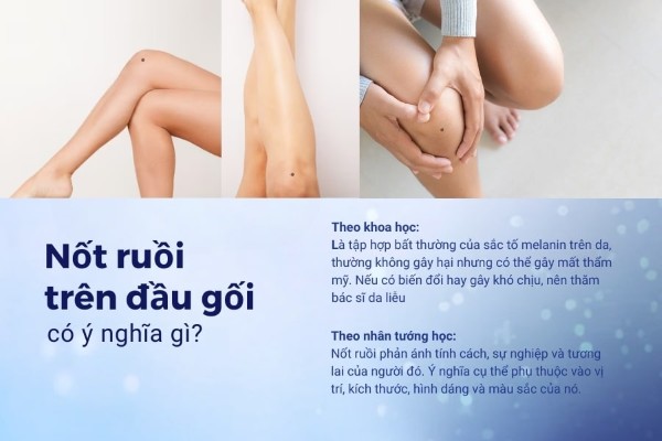 Nốt ruồi trên đầu gối có ý nghĩa gì