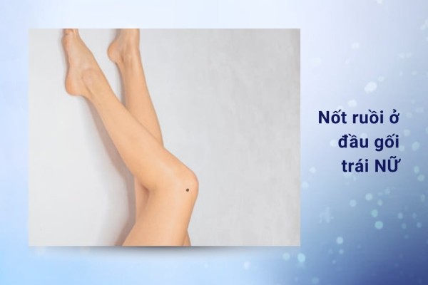 Nốt ruồi ở đầu gối trái nữ – Sự nghiệp thăng tiến, tình duyên trắc trở