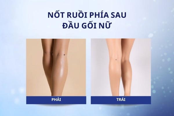 Ý nghĩa nốt ruồi phía sau đầu gối nữ là gì?
