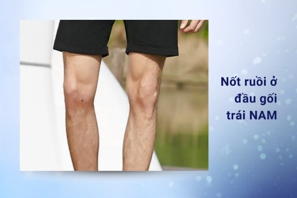 Nốt ruồi ở đầu gối trái nam – Sự nghiệp thành công, tình cảm viên mãn