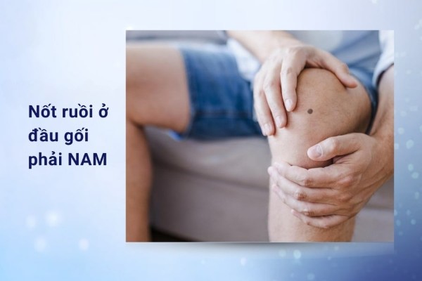 Nốt ruồi ở đầu gối bên phải nam – Người hiền lành, chân thật