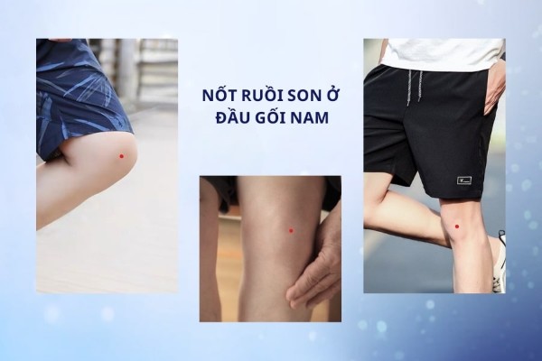 Đàn ông có nốt ruồi đỏ ở đầu gối sẽ là người như thế nào?