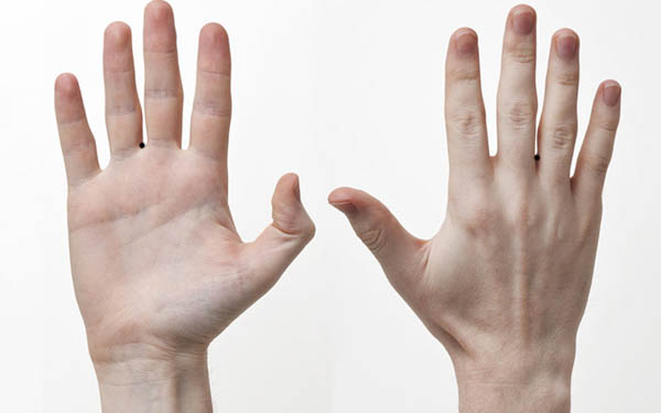 Nốt ruồi ở kẽ ngón tay giữa và áp út Nốt ruồi ở kẽ ngón tay giữa và áp út