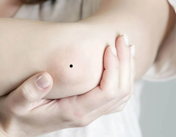 Luận giải ý nghĩa nốt ruồi ở khuỷu tay trái Luận giải ý nghĩa nốt ruồi ở khuỷu tay trái
