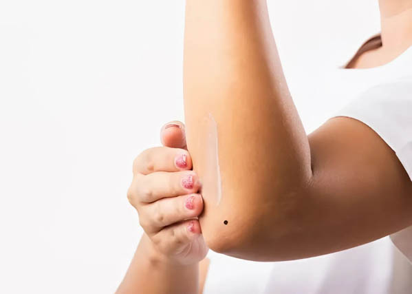 Ý nghĩa nốt ruồi ở bên ngoài khuỷu tay Ý nghĩa nốt ruồi ở bên ngoài khuỷu tay