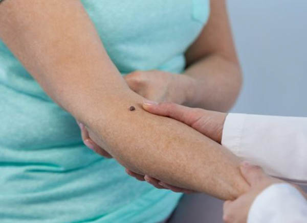 Có nên tẩy nốt ruồi ở khuỷu tay không? Có nên tẩy nốt ruồi ở khuỷu tay không?