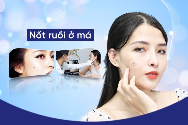 Nốt ruồi ở má tiết lộ điều gì ở tương lai? Có nên xóa không?