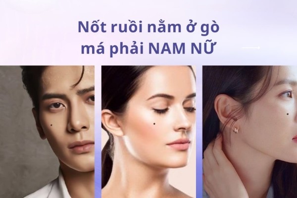 Nốt ruồi nằm ở gò má phải – Nữ lận đận, nam thành công