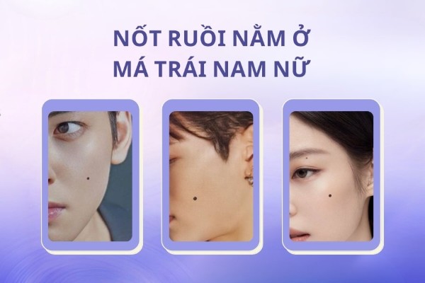 Nốt ruồi nằm ở má trái nam có ý nghĩa không may mắn