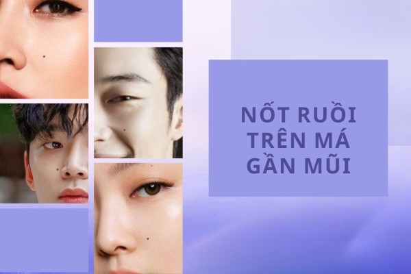 Nốt ruồi xương gò má cạnh mũi là tốt hay xấu?