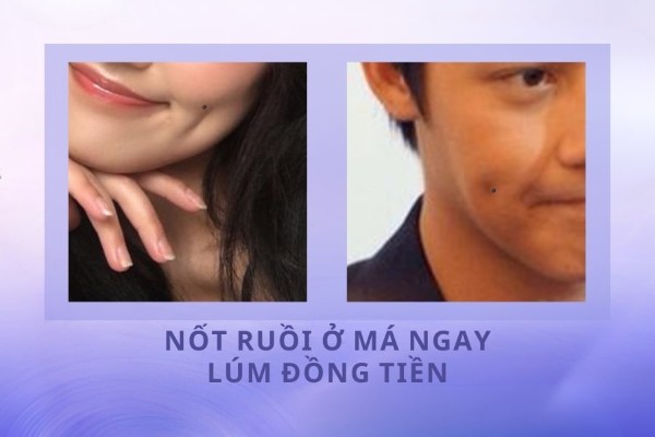Nốt ruồi trên má vị trí lúm đồng tiền