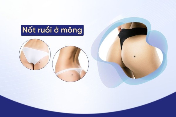 Nốt ruồi ở mông thường mang đến những điềm báo gì? 