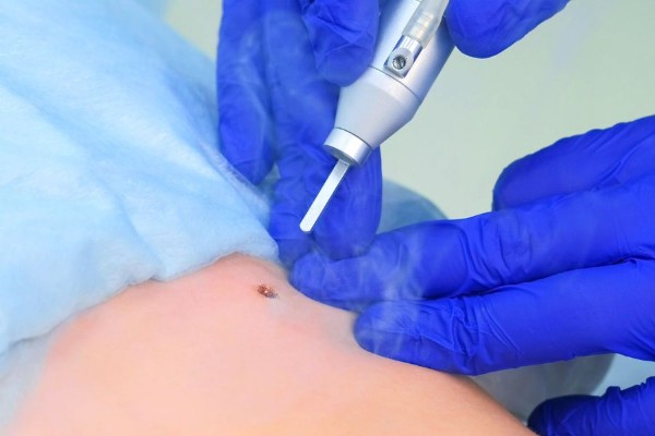 Việc có nên tẩy/xóa nốt ruồi hay không hoàn toàn phụ thuộc vào quyết định của bạn