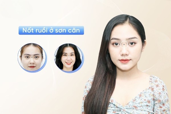 Nốt ruồi ở sơn căn là điềm xấu hay điềm tốt? 