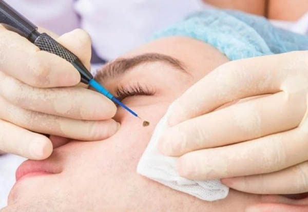 Có nên tẩy xóa nốt ruồi sát phu hay không?