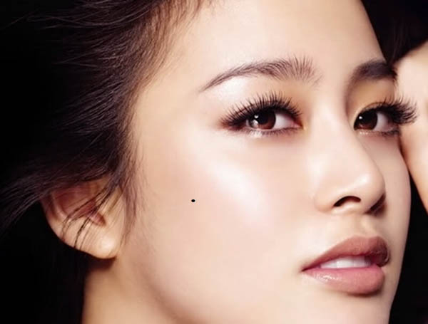 Nốt ruồi ở xương gò má trái