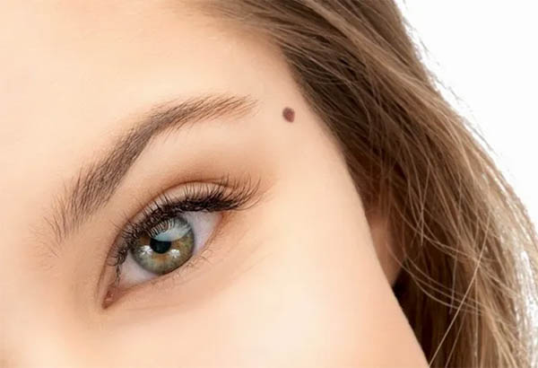 Nốt ruồi sát chồng ở đuôi mắt