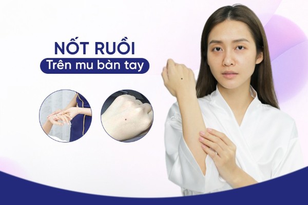 Bí mật nốt ruồi trên mu bàn tay: Dấu hiệu vận mệnh tốt hay xấu? Bí mật nốt ruồi trên mu bàn tay: Dấu hiệu vận mệnh tốt hay xấu?