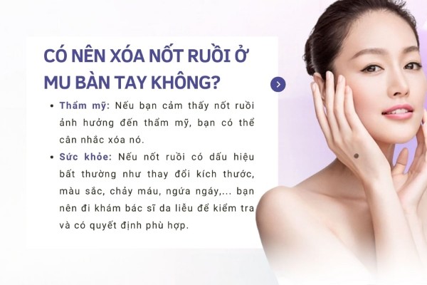 Có nên xóa nốt ruồi ở mu bàn tay không? Có nên xóa nốt ruồi ở mu bàn tay không?