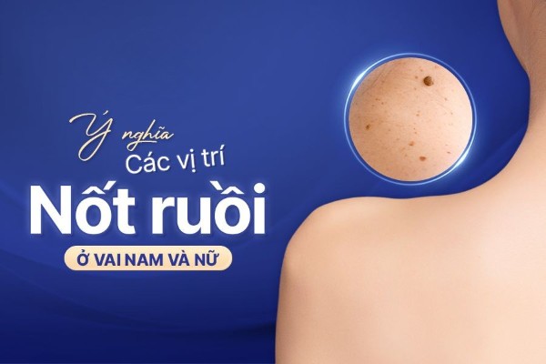 Ý nghĩa các vị trí nốt ruồi ở vai