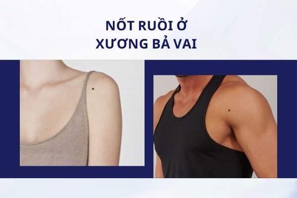 Mụn ruồi ở vai mang ý nghĩa tốt đẹp cho sự nghiệp và tình duyên