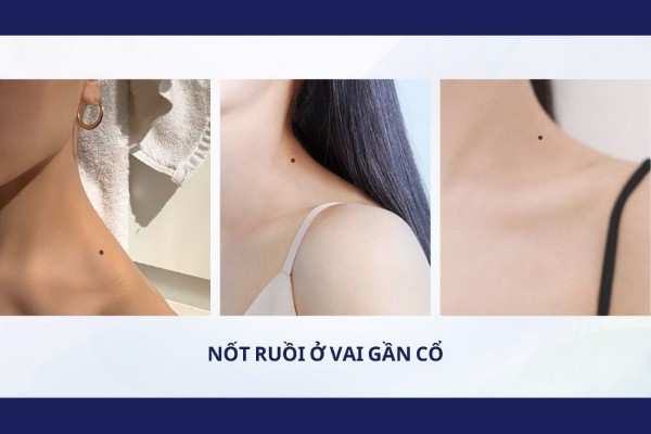 Nốt ruồi ở vai gần cổ – Không có số làm giàu