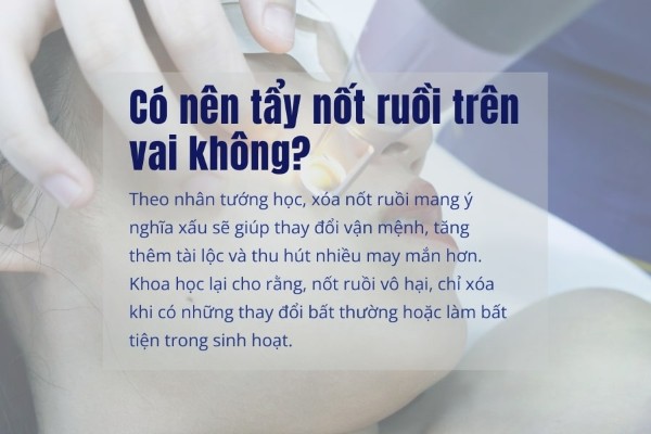 Có nên tẩy nốt ruồi trên vai không?