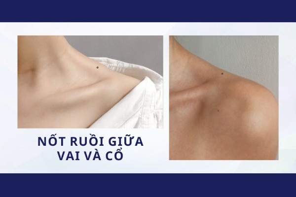 Nốt ruồi giữa vai và cổ là nốt ruồi quý