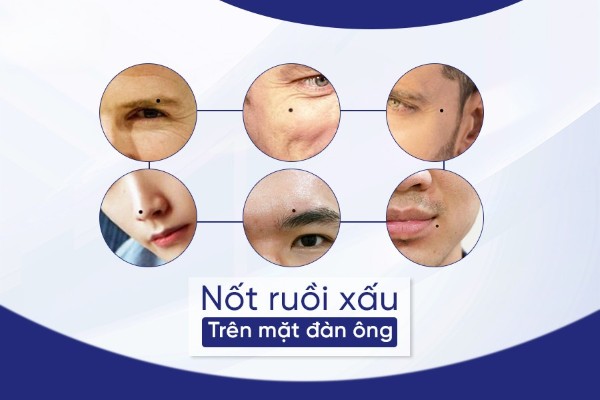 Xem tướng nốt ruồi xấu trên mặt đàn ông đoán ngay tính cách