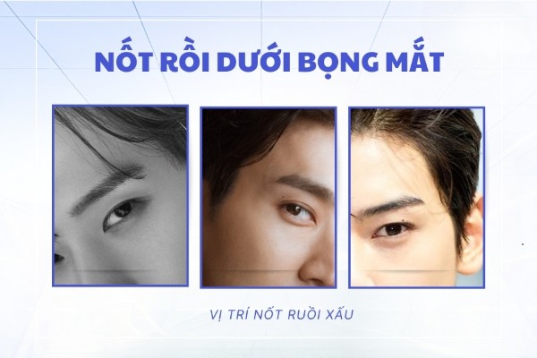 Nốt ruồi dưới bọng mắt – Biểu hiện người gia trưởng, khó tính