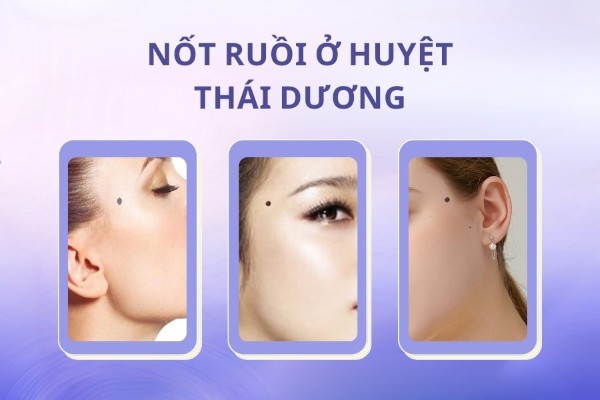 Những vị trí nốt ruồi KHÔNG NÊN tẩy tránh ảnh hưởng tới tướng số
